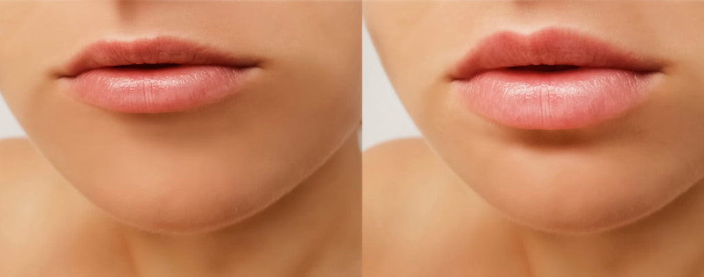 Lip Remodeling & Contouring Treatment - Boutique 24Skin Care